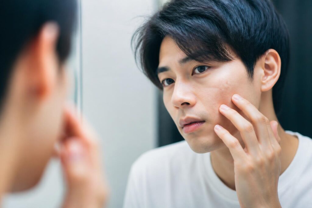 ニキビ跡に効果的なクリームは安いものでも本当に効果がある？