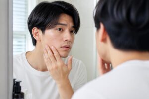 男性のニキビ跡に効果的なフラクショナルレーザーとは？